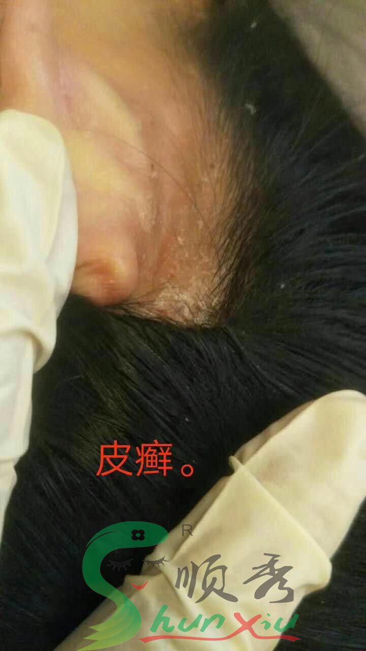 皮炎--2（1）.jpg