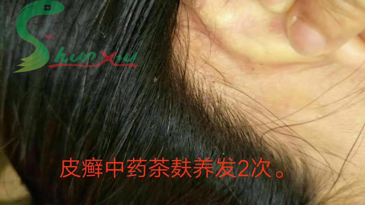 皮炎--2（2）.jpg