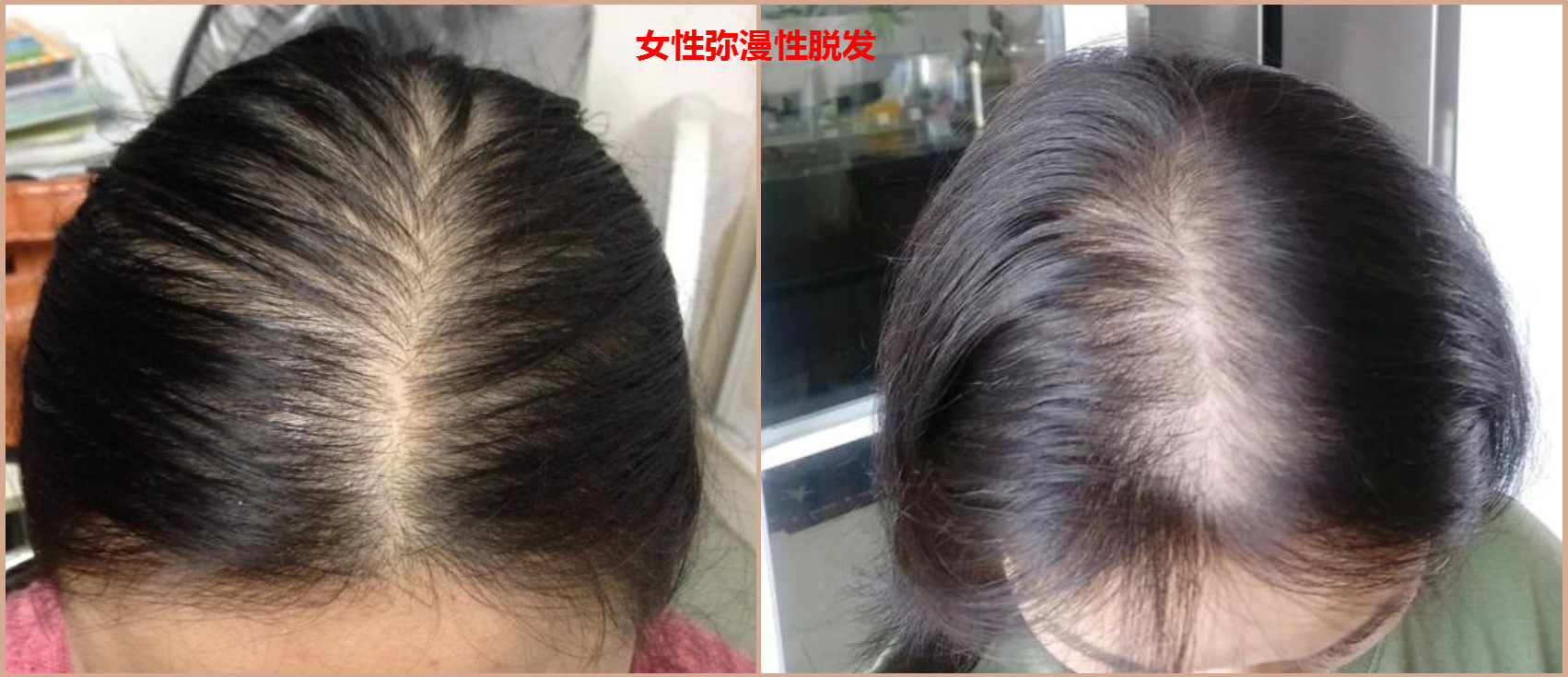 彌漫性脫發圖