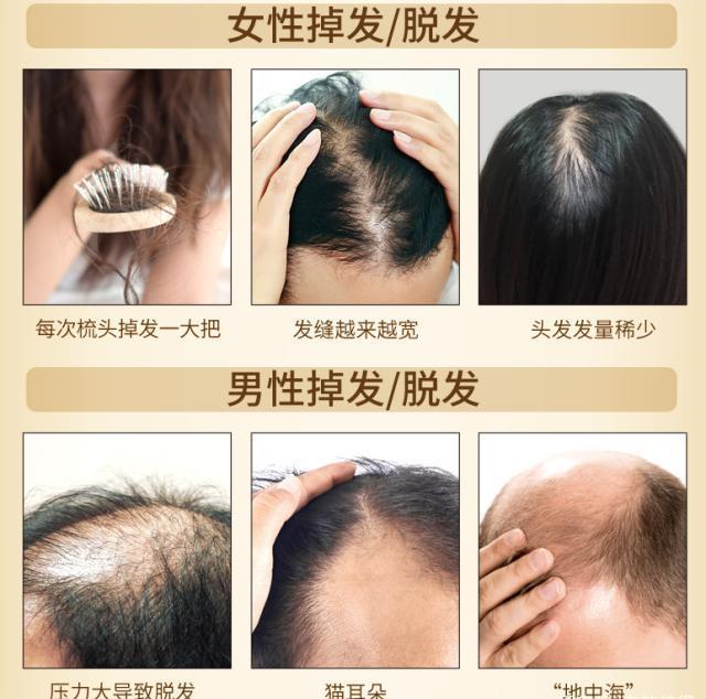 男性、女性脫發
